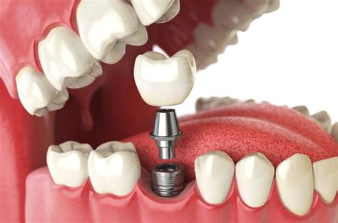 implante dentario|implante dentário o que é.